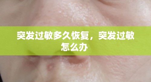 突發(fā)過(guò)敏多久恢復(fù)，突發(fā)過(guò)敏怎么辦 