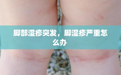 腳部濕疹突發(fā)，腳濕疹嚴重怎么辦 